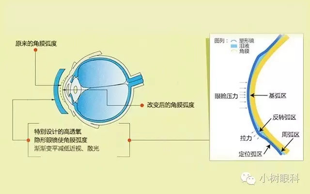 目前没有任何医疗手段可以治愈近视,角膜塑形镜只是暂时改变眼睛的